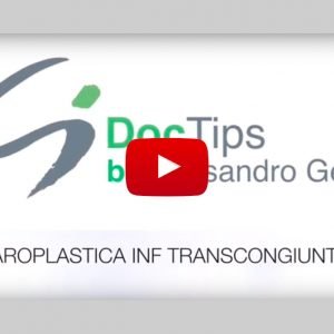 blefaroplastica inferiore transcongiuntivale doctips